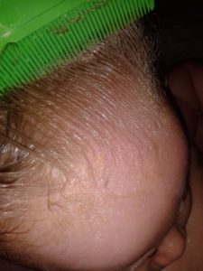 Looking for a natural cradle cap remedy? The solution is closer and easier than you think. Infants and toddlers can have a clear scalp. Coconut oil is one natural remedy - learn all 3! Learn how to get rid of cradle cap on your baby today! @naturalsoapmom.com #cradlecap #naturalbaby #babyskinproblems #haircare #coconutoil #bakingsoda #cradlecapshampoo #Babycare #Newborn #Naturalskincare #Cradlecap #Babies #Babyskin 