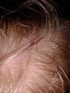 Looking for a natural cradle cap remedy? The solution is closer and easier than you think. Infants and toddlers can have a clear scalp. Coconut oil is one natural remedy - learn all 3! Learn how to get rid of cradle cap on your baby today! @naturalsoapmom.com #cradlecap #naturalbaby #babyskinproblems #haircare #coconutoil #bakingsoda #cradlecapshampoo #Babycare #Newborn #Naturalskincare #Cradlecap #Babies #Babyskin